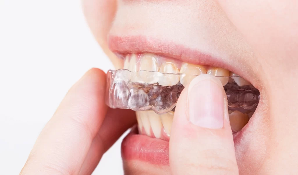How to Care For Your Dental Guard Effectively